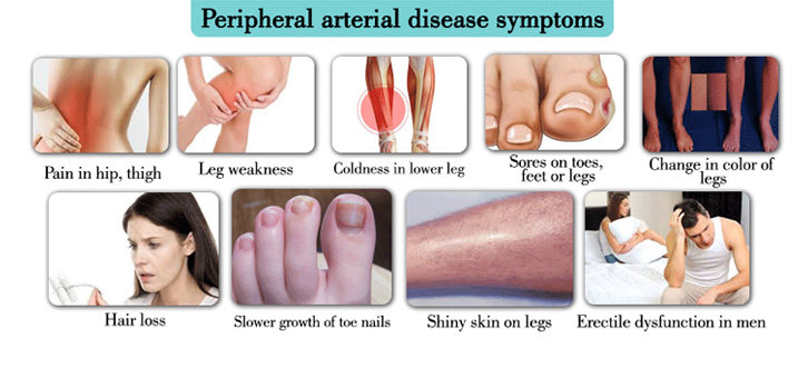 Peripheral Arterial Disease Symptoms