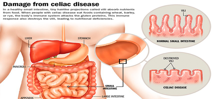 Symptoms and Treatment of Celiac Disease
