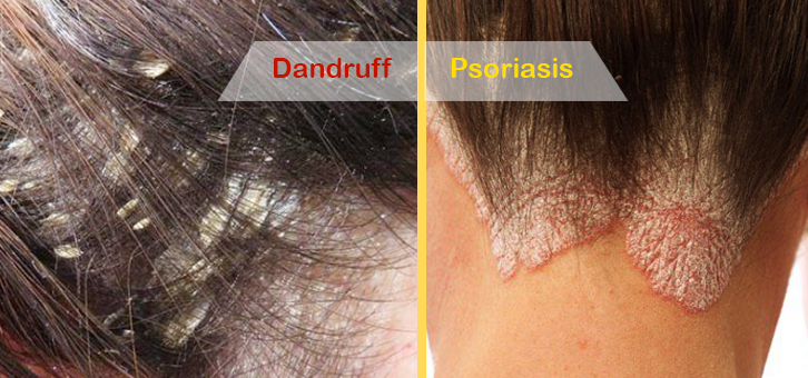 Psoriasis flakes on scalp - Égő psoriasis