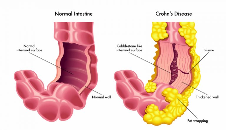 crohn-s-disease-a-common-life-threatening-illness-sambav-blog