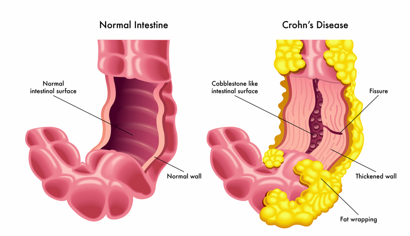 Crohn's Disease- A Common Life Threatening Illness ...