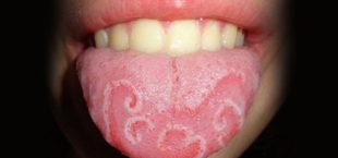 Glossitis or Geographic Tongue