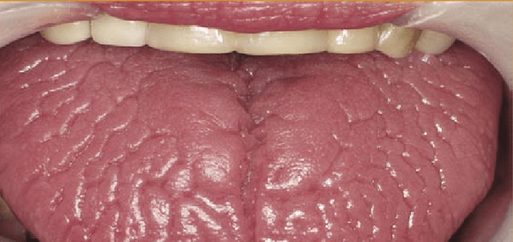 Glossitis or Geographic Tongue