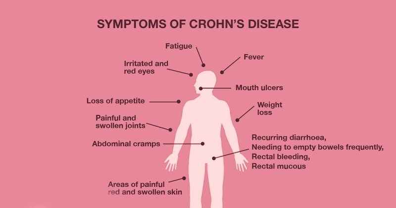 Symptoms of Crohns Disease